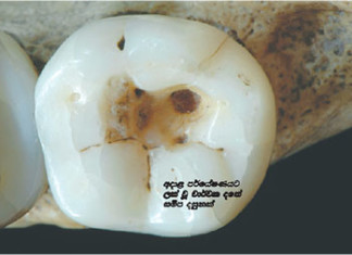 දන්ත ව්යසනයකට මුලින් ම පිළියම් කළේ වසර 14,000කට පෙර