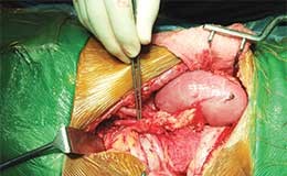 තාත්තාට පුතාගෙන් වුව හිතුමතේ වකුගඩුවක් දෙන්න බැහැ – Kidney Transplant Sri Lanka kidney-transplant