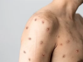 Monkeypox – Sri Lanka monkeypox sri lanka