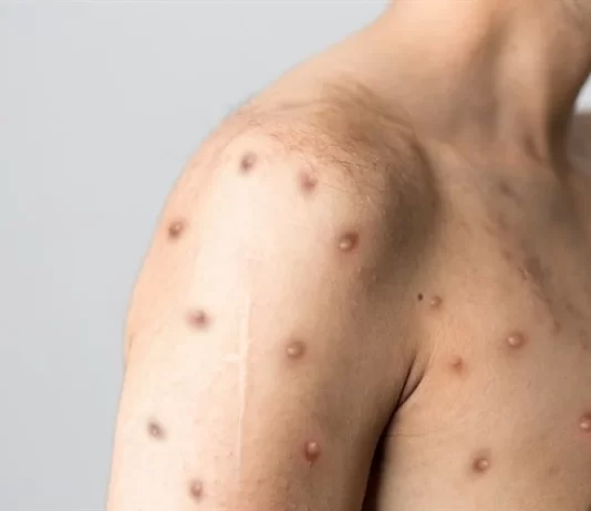 Monkeypox – Sri Lanka monkeypox sri lanka
